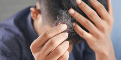 Hair loss - generic image of a man pulling a clump of hair from his head.